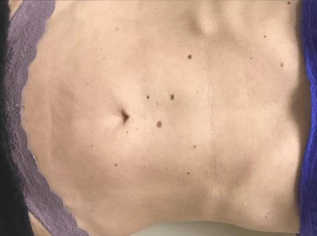 Fractora in Ottawa - MedicSPA Gatineau