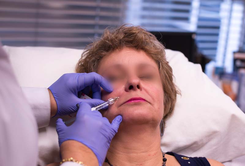 Woman getting dermal filler injection around mouth