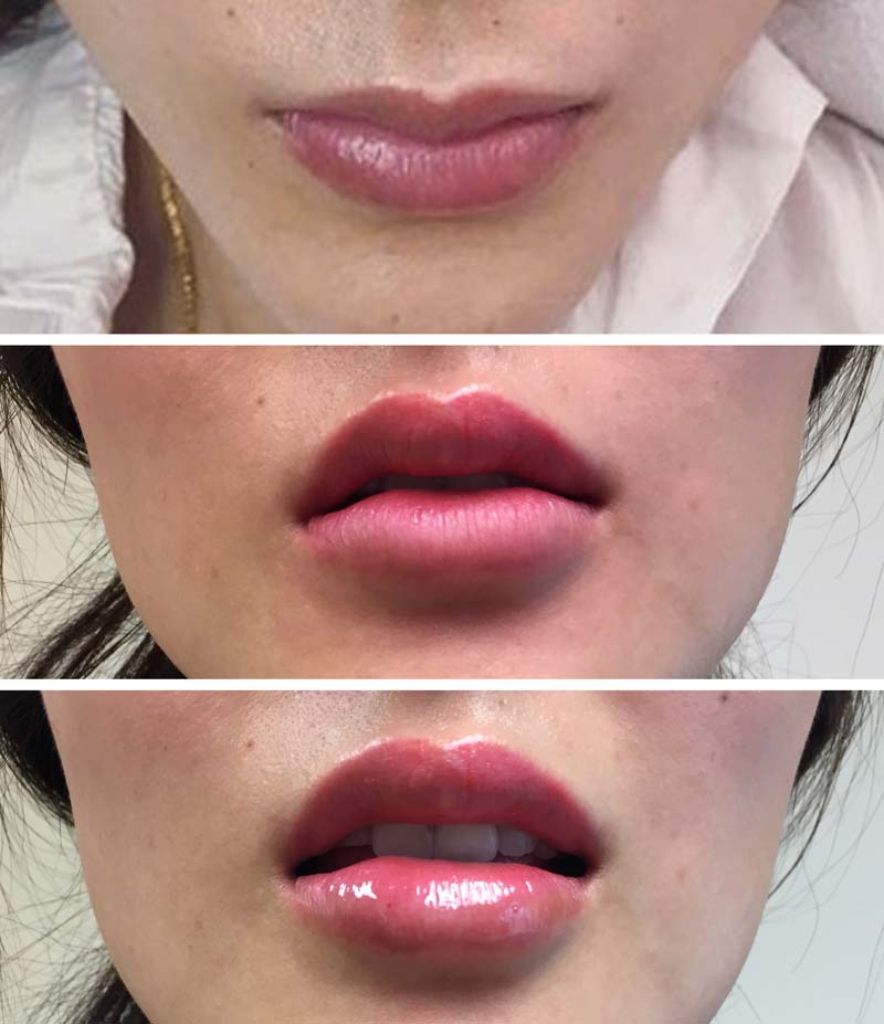 Dermal Filler result progress on female patient