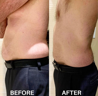 A man's body before and after a SculpSure treatment.