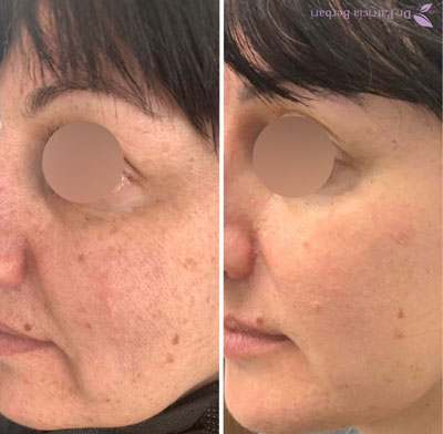 A woman's face before and after Fractora treatment.