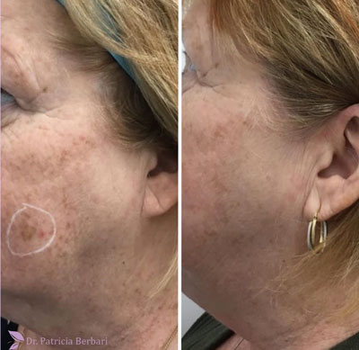 Side profile of a woman's face before and after Lumecca™ IPL skin treatment.