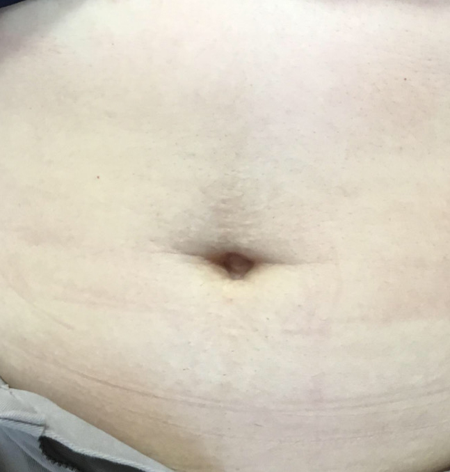 Tummy Tuck Scar Aftercare - Gatineau, QC - Dr. Patricia Berbari