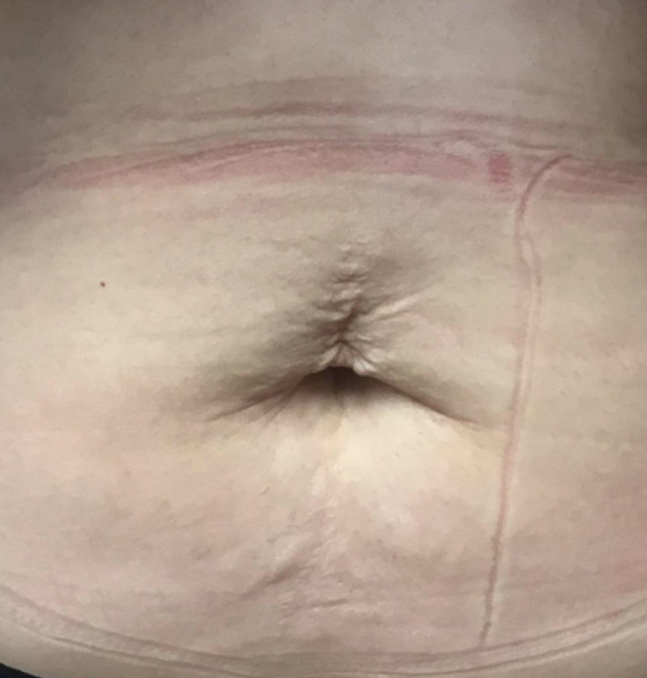 Tummy Tuck Scar Aftercare - Gatineau, QC - Dr. Patricia Berbari