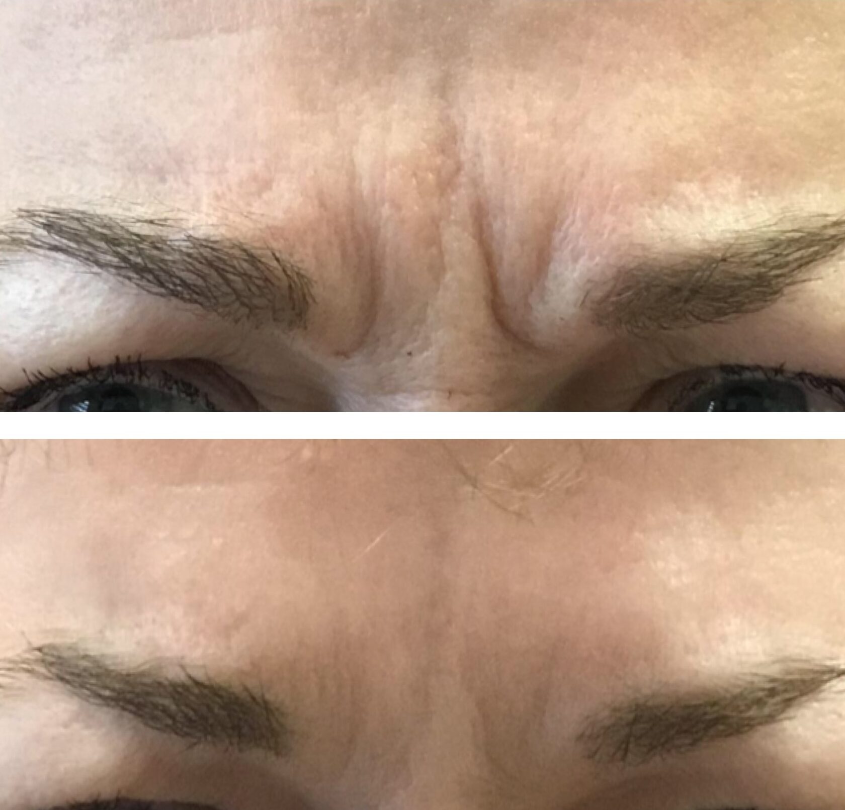 20 units of neurotoxin to treat frown lines between the eyebrows