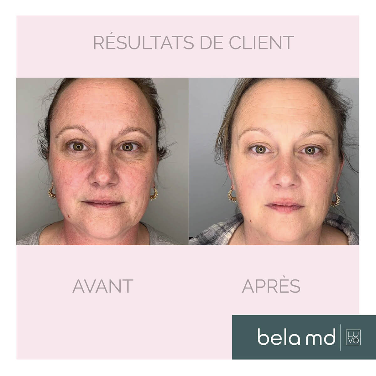 Before and after results 1