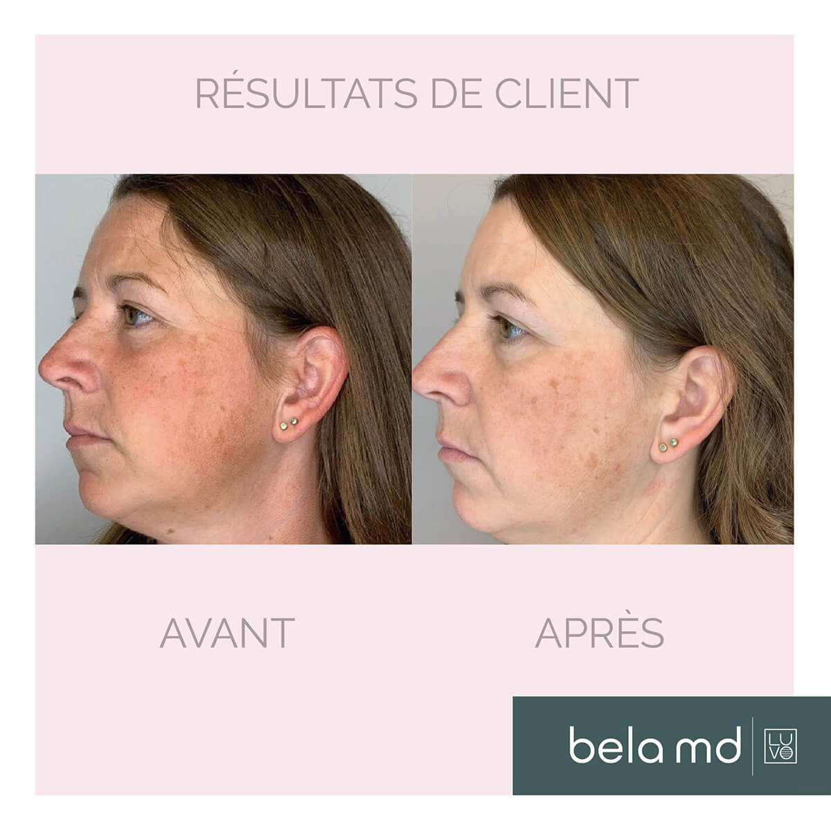 Before and after results 4