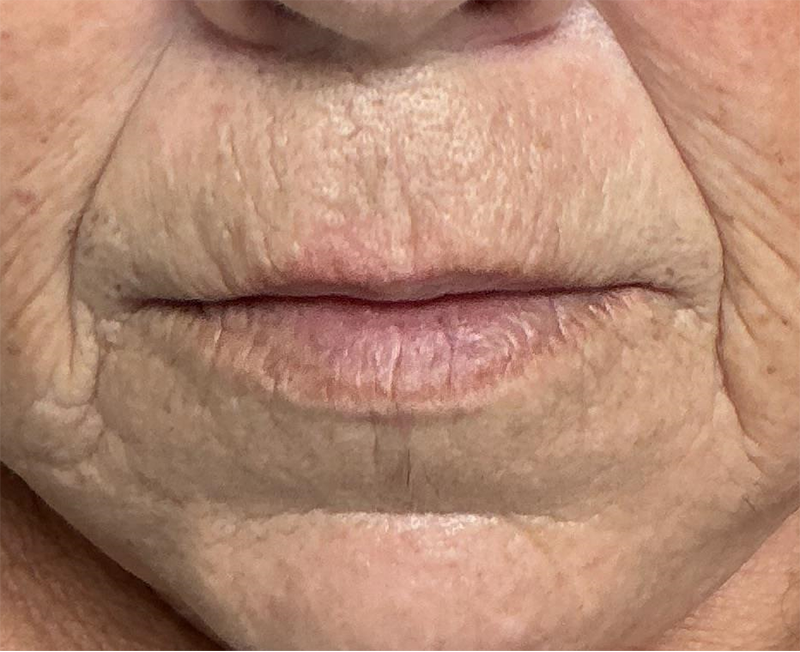 * Ces photos sont publiées à titre indicatif afin de fournir l’information sur la nature de l’intervention. Elles ne constituent aucunement une garantie de résultat.