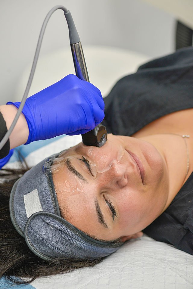 Upper face skin lift with radio frequency