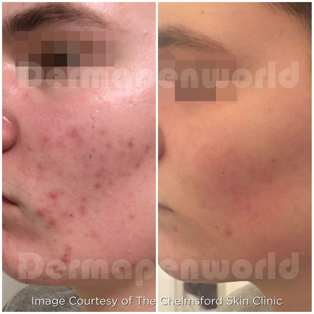 Microneedling results 3