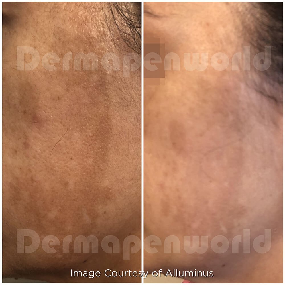 Microneedling results 1