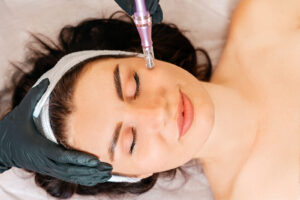 Woman during her microneedling treatment